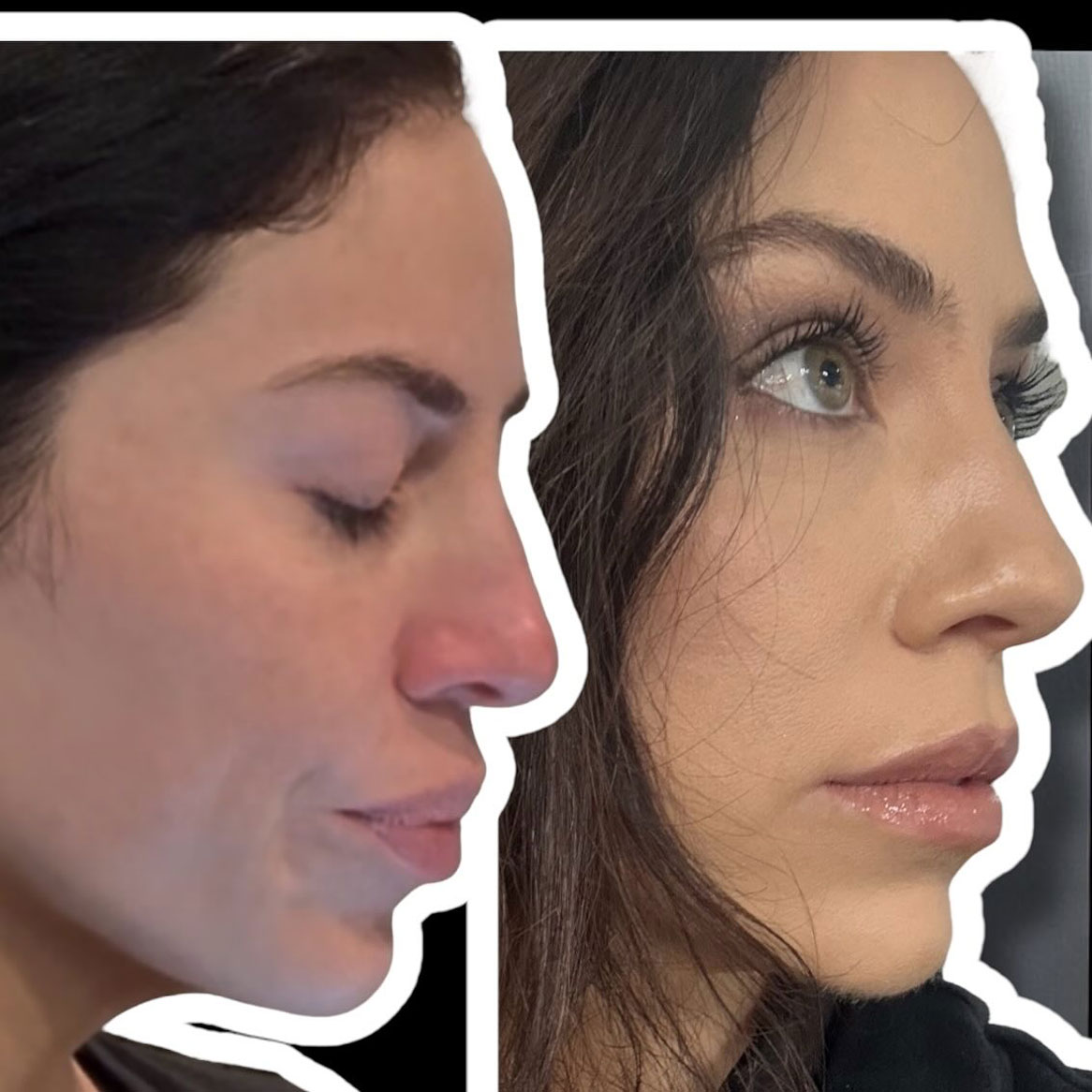 BOTOX Injections in Virginia Beach, VA