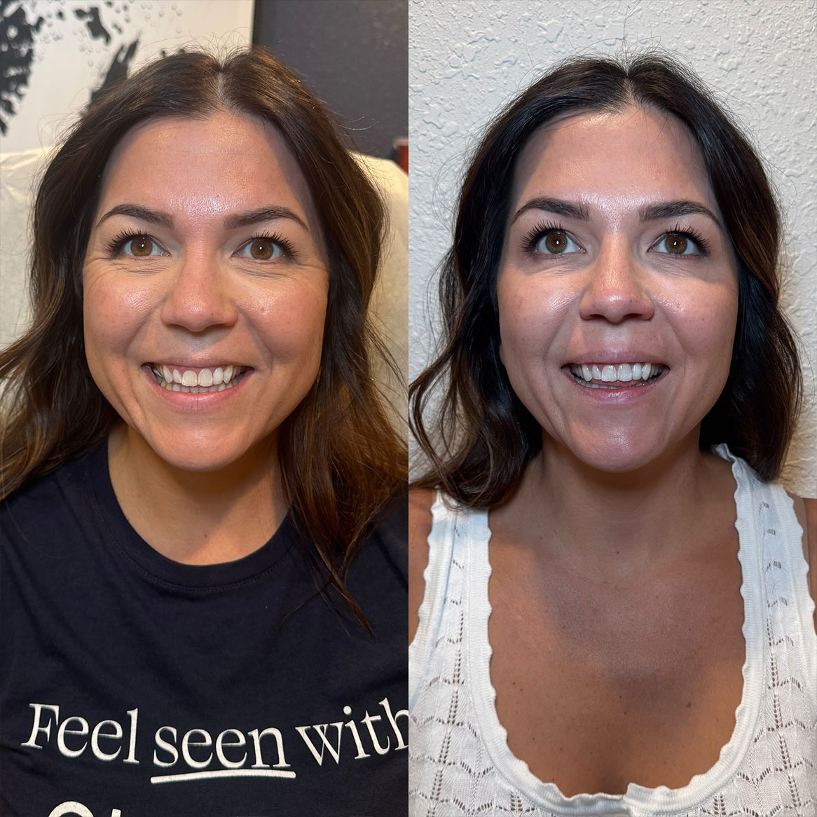 Before-and-after of Botox treatment for forehead lines at a Virginia Beach med spa Before-and-after of Botox treatment for forehead lines at a Virginia Beach med spa
