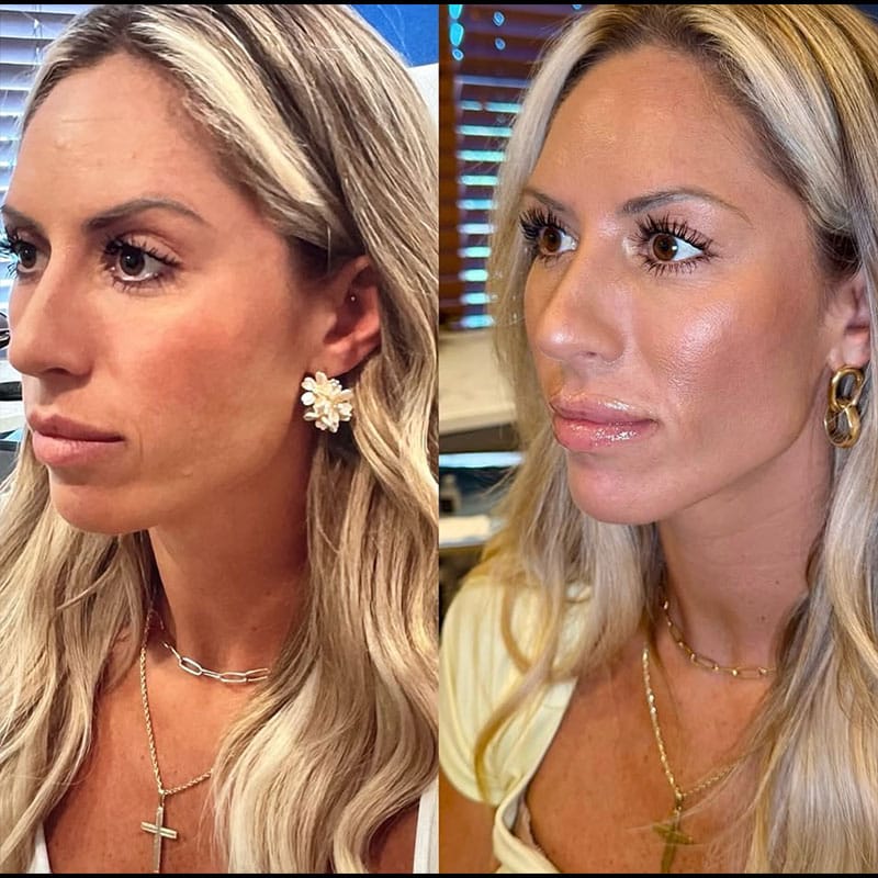 Before-and-after of dermal filler results at a Virginia Beach med spa