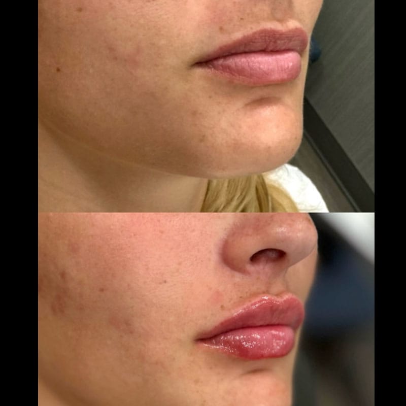 Before-and-after of lip filler results at a Virginia Beach med spa Before-and-after of lip filler results at a Virginia Beach med spa
