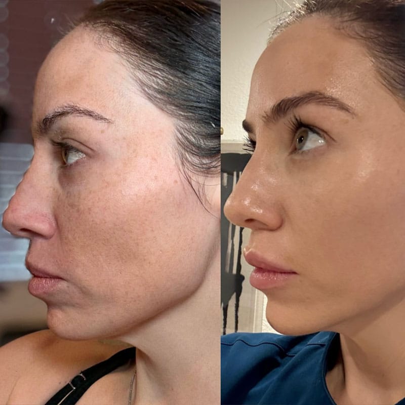 Before-and-after of microneedling skin rejuvenation results at a Virginia Beach med spa