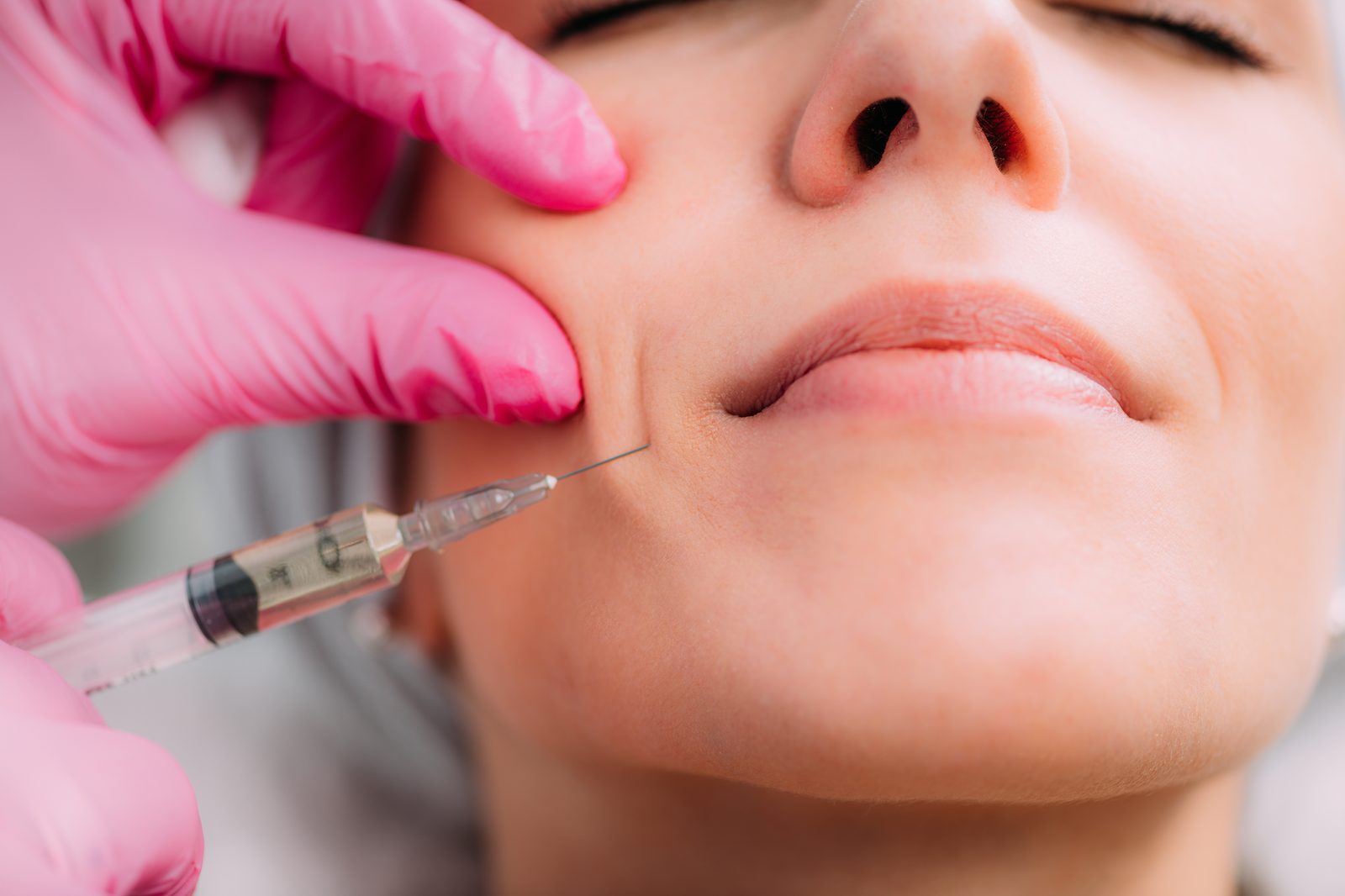 Clinician injecting dermal filler into a patient's nasolabial fold during a treatment at a Virginia Beach aesthetics practice