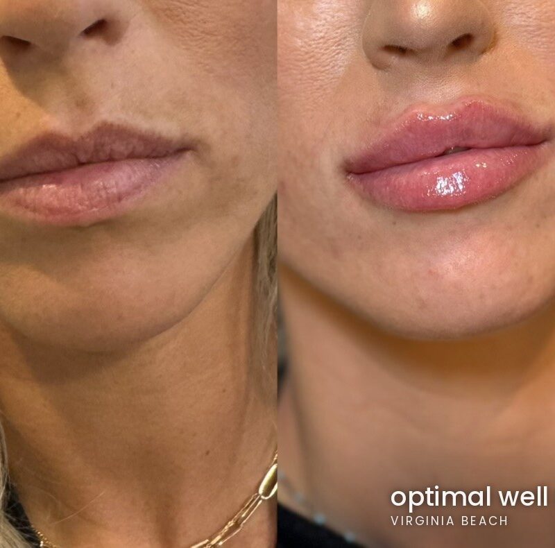 Front view before and after comparison showing lip filler results for a patient treated at Optimal Well MD in Virginia Beach; individual results vary Front view before and after comparison showing lip filler results for a patient treated at Optimal Well MD in Virginia Beach; individual results vary
