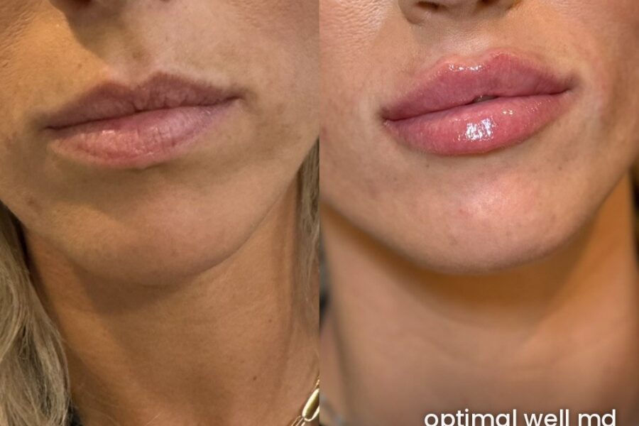 Front view before and after comparison showing lip filler results for a patient treated at Optimal Well MD in Virginia Beach; individual results vary