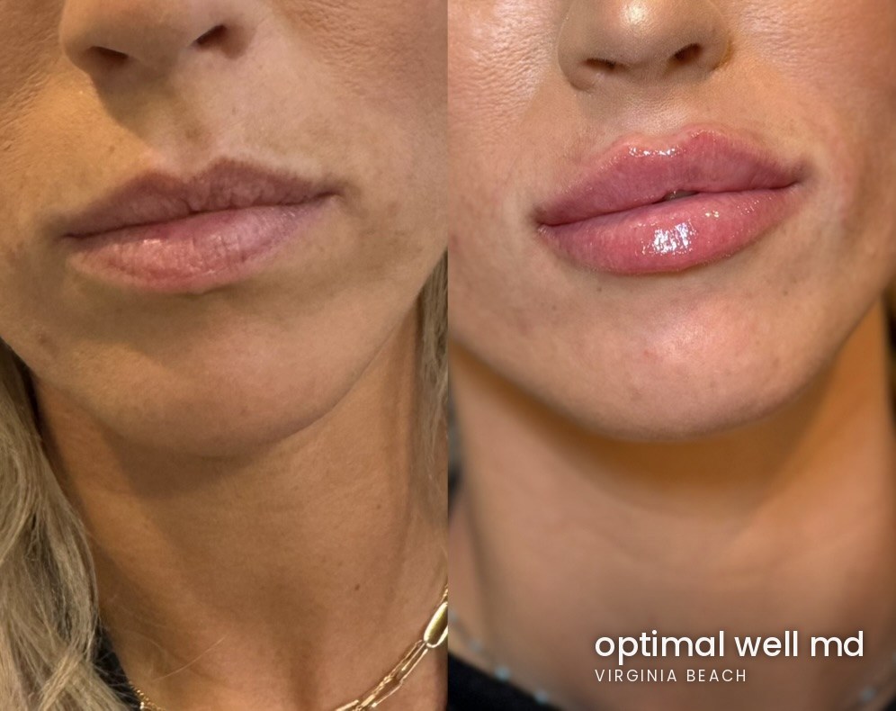 Front view before and after comparison showing lip filler results for a patient treated at Optimal Well MD in Virginia Beach; individual results vary