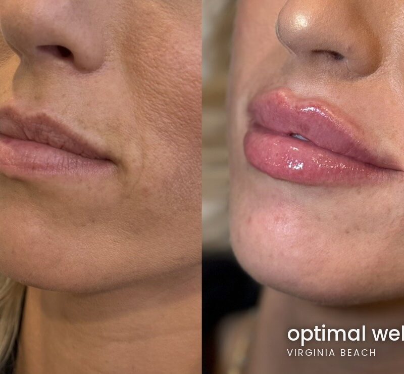Side profile before and after comparison showing lip filler results for a patient treated at Optimal Well MD in Virginia Beach; individual results vary