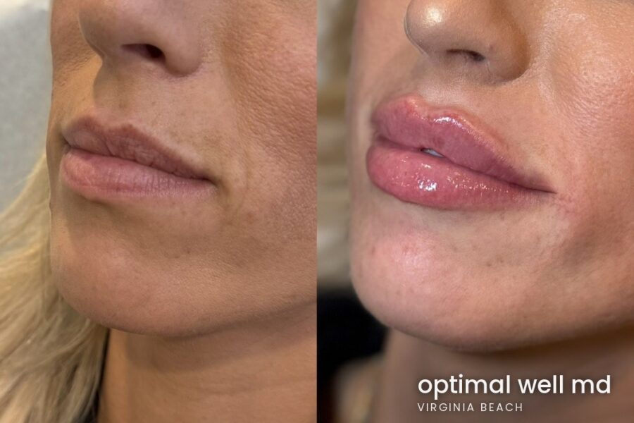 Side profile before and after comparison showing lip filler results for a patient treated at Optimal Well MD in Virginia Beach; individual results vary