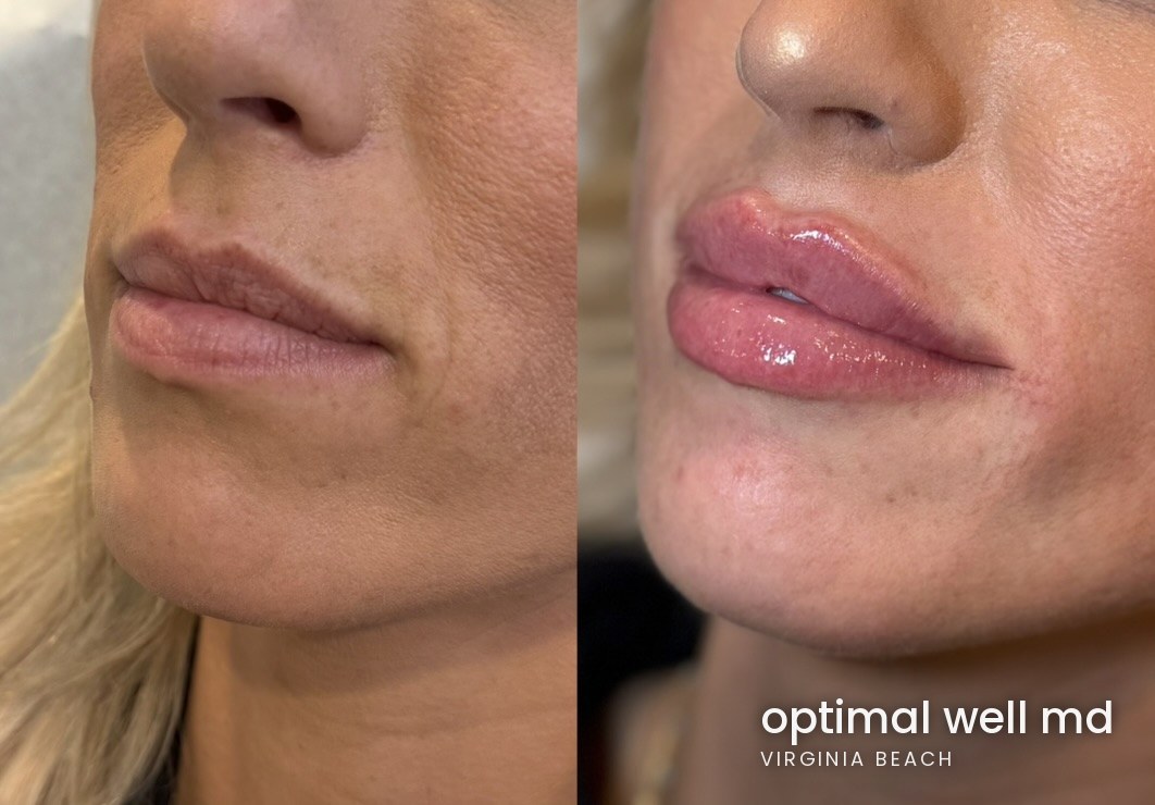 Side profile before and after comparison showing lip filler results for a patient treated at Optimal Well MD in Virginia Beach; individual results vary