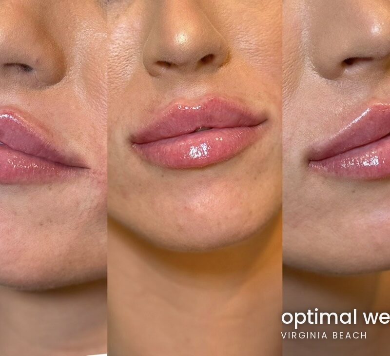 Three-angle view of lip filler results for a patient treated at Optimal Well MD in Virginia Beach; individual results vary