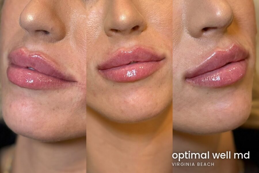 Three-angle view of lip filler results for a patient treated at Optimal Well MD in Virginia Beach; individual results vary