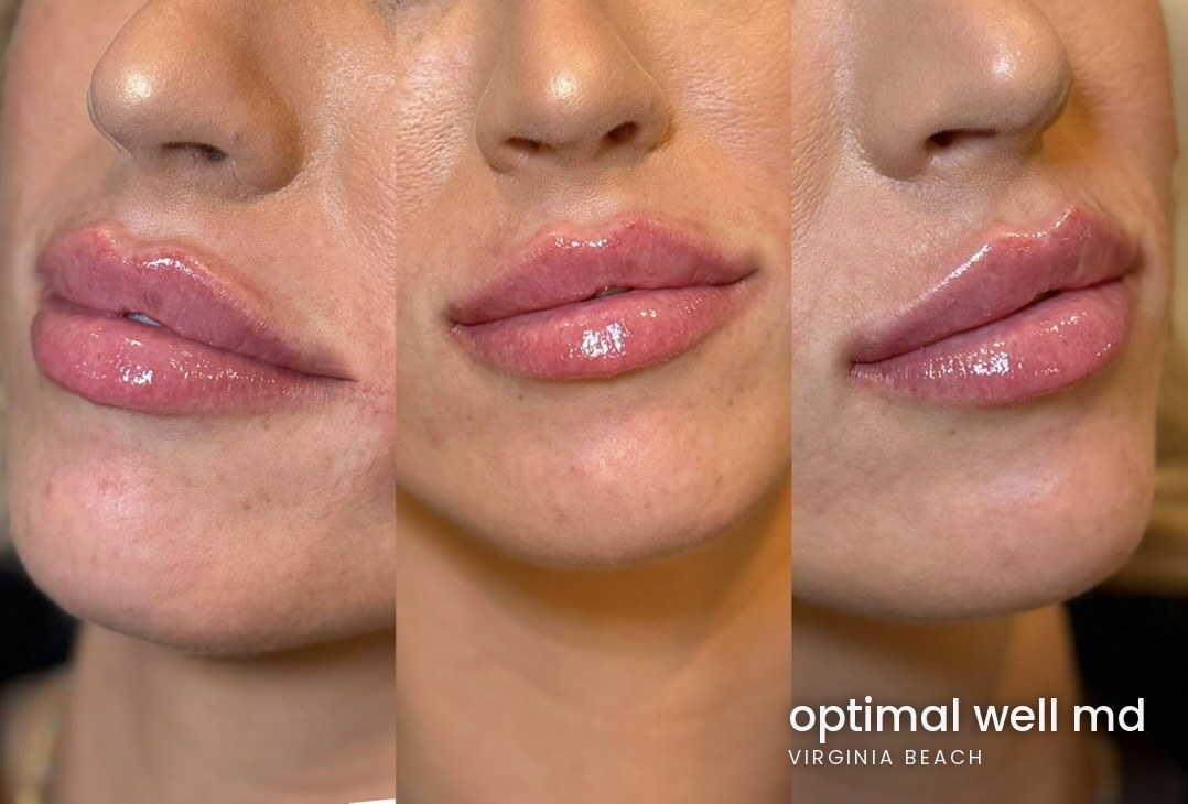 Three-angle view of lip filler results for a patient treated at Optimal Well MD in Virginia Beach; individual results vary
